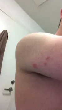 Bed bug bite marks on skin