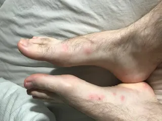 Bed bug bites on feet requiring professional treatment